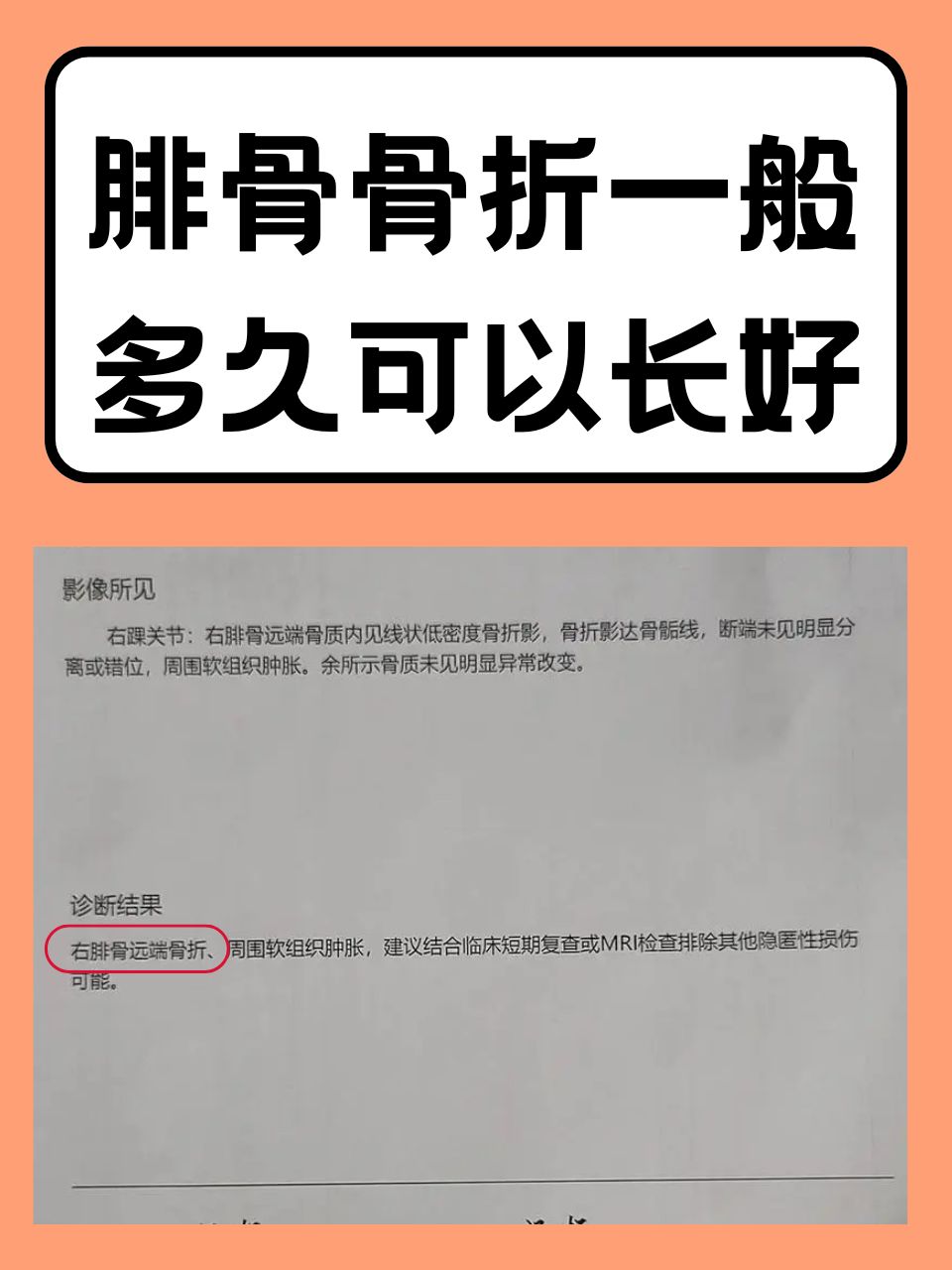 od体育官网-拜仁新星穆西亚拉腓骨骨折，将缺阵至少四个月！